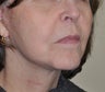 Facelift