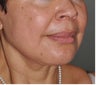 Facelift