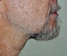 Direct Necklift