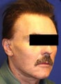 Facelift Surgery