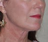 Facelift