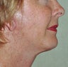 Facelift