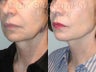Sluplift- Mini Neck & Jowl Lift