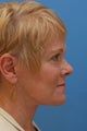 Face & Neck Lift, Facial Fat Grafting, Upper and Lower Eyelid Lifts, Perioral Dermabrasion