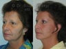 Sluplift Neck & Jowl Lift and Upper Blepharoplasty