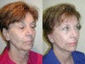 Sluplift Neck & Jowl Lift, Upper and Lower Blepharoplasty
