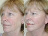 Sluplift- Mini Neck & Jowl Lift