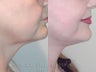 Sluplift- Mini Neck & Jowl Lift
