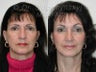 Endoscopic Brow Lift, Sluplift Neck & Jowl Lift & Lower Blepharoplasty
