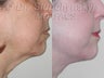 Sluplift- Mini Neck & Jowl Lift