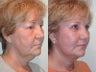 Facelift, Upper & Lower Blepharoplasty