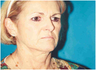 Brow and Face Lift Upper Blepharoplasty with Lip Augmentation