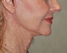 Facelift