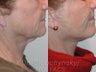 Sluplift- Mini Neck & Jowl Lift