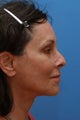 Face & Neck Lift, Browlift, Facial Fat Grafting