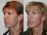 Facelift, Upper & Lower Blepharoplasty
