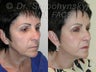 Sluplift- Mini Neck & Jowl Lift