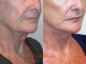 Sluplift- Mini Neck & Jowl Lift