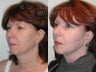 Facelift