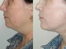 Sluplift- Mini Neck & Jowl Lift & Submental Liposuction