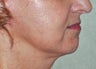Facelift