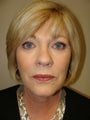 Facelift with quad blephorplasty