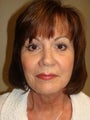 Facelift with browlift and lower blephorplasty