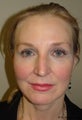 Facelift with browlift and lower blephorplasty