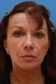 58 Year Old Lady After Revision Facelift