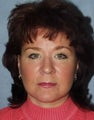 Facelift with Necklift