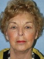 Facelift with Necklift