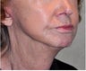 Facelift