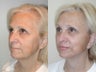 SLUPLift, Endoscopic Forehead Lift and Lower Blepharoplasty