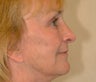 Face Lift, Blepharoplasty, and Brow Lift
