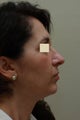 Facial Surgery for Rejuvenation