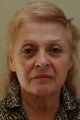 Facial Rejuvenation