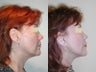 Mini jowl and neck lift - SLUPlift