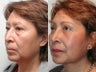 Minifacelift Blepharoplasty