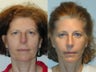 Full Facelift - Browlift, lower blepharoplasty, Lower Facelift