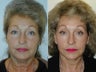 Midface lift - lower minifacelift - upper and lower blepharoplasty