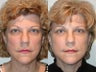Deep Plane Facelift - Endoscopic Forehead Lift