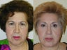 Composite Facelift, Upper and Lower Blepharoplasty