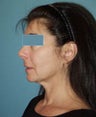 Facelift