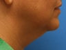 Lower Facelift with Submental Liposuction (Liposuction under the chin)