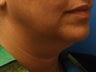 Lower Facelift with Submental Liposuction (Liposuction under the chin)