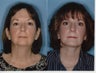 Facelift