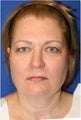 Facelift and Necklift