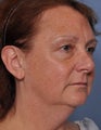 Facelift
