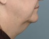Facelift
