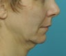 Facelift
